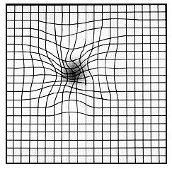 Amsler Grid as perceived by a Patient with AMD Figure 3: Showing two abnormal features: Distortions of AG