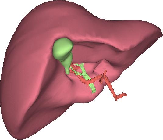 Figure 1-a Opaque representation This representation corresponds to what the surgeon sees during a real surgical operation.
