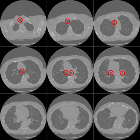 Figure 1. Airways in chest CT slices. Trachea and main bronchi are marked with circles. Each main bronchus splits further into smaller bronchial tubes.
