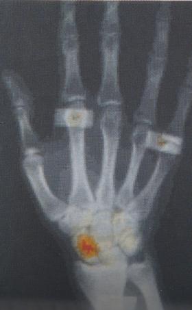 Wrist Registration Splint with cobalt markers UV