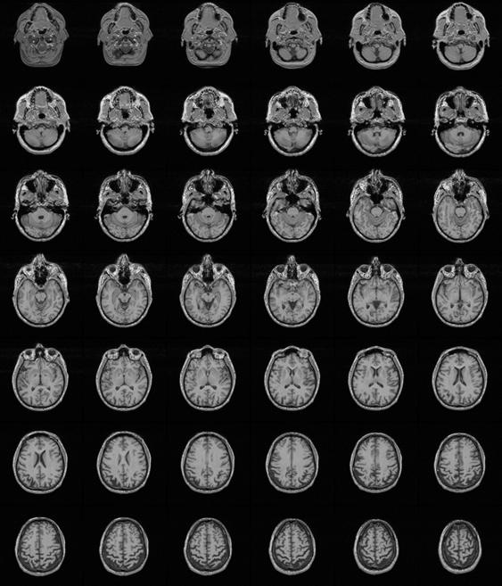 3D MRI An MR camera gives a 3D image.