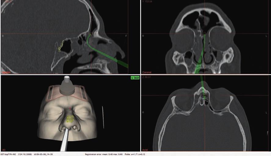 Visualization of the navigated frontal sinus