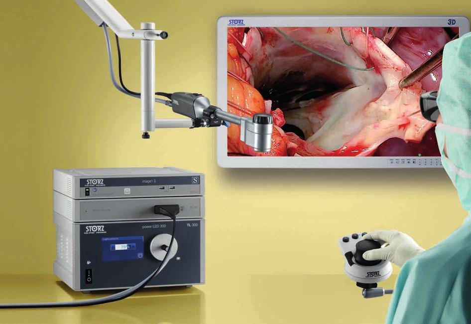 VITOM 3D 3D Visualization for Open Heart Surgery The VITOM 3D system provides many surgical disciplines with a revolutionary solution for the visualization of microsurgical and open surgical