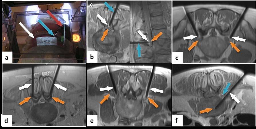 Figure 3-11: a) Intra-procedural photograph similar to the operator s view with the MR image projected onto the subject, laser line (white arrow), virtual needle path (blue arrow) and operator s hand