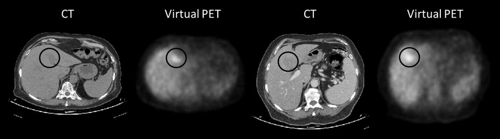 8 Ben-Cohen et al. tumors (TPR of 92.3%) with only 2 false positives for all 8 scans (average FPR of 0.25). Fig.