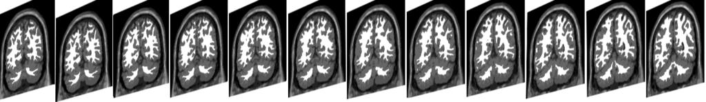 intensity homogeneities and inhomogeneities. According to Zidenbos [24] statement that AOM > 0.7 indicates excellent agreement; our technique has desired performance in cortical segmentation.