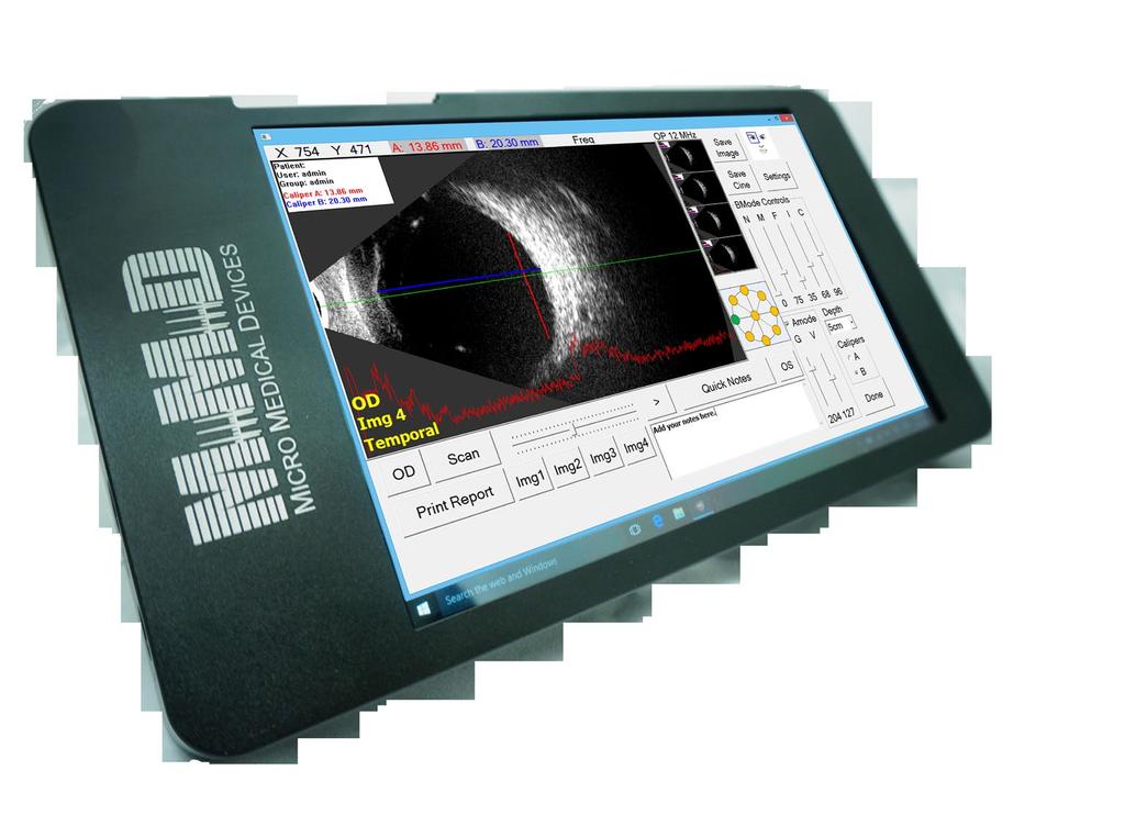 Mobile B-Scan has a probe frequency of 15MHz, a 3 to 10 cm penetration depth and with its dual calipers you can easily measure the structure within the eye.