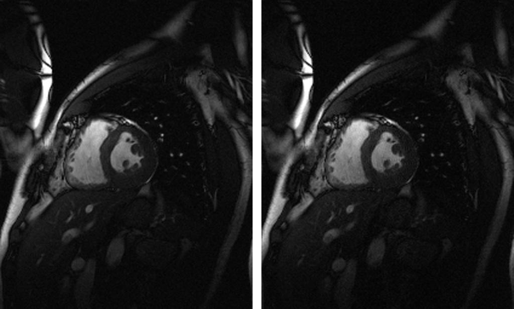 1208 Griswold et al. FIG. 7. Segmented TrueFISP cine images. Left: Standard full-time acquisition and sum of squares reconstruction. Right: GRAPPA reconstruction with acceleration factor of two.