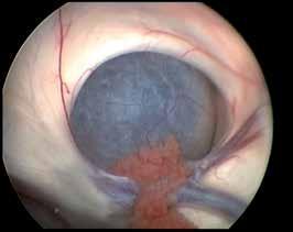 10: Biopsy of a tumor in foramen