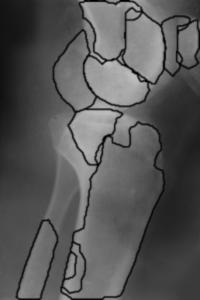 detection of bone contours in medical X-ray images.