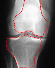 In this paper we propose an approach for automatic bone contours detection which does not require homogeneity of regions. It can be used for joint recognition in X-ray images.