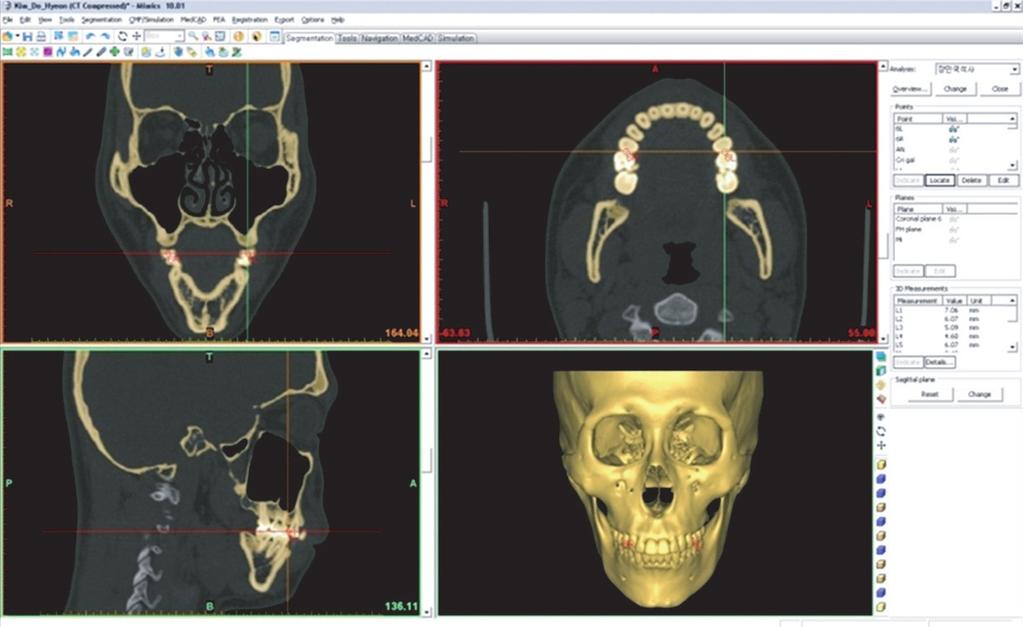 CT imaging CT scans were performed with the subject's Frankfurt horizontal plane perpendicular to the ground and the midsagittal plane aligned with the long axis of the machine (six channel, 400 V,