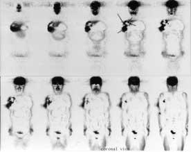 Scintigraphy