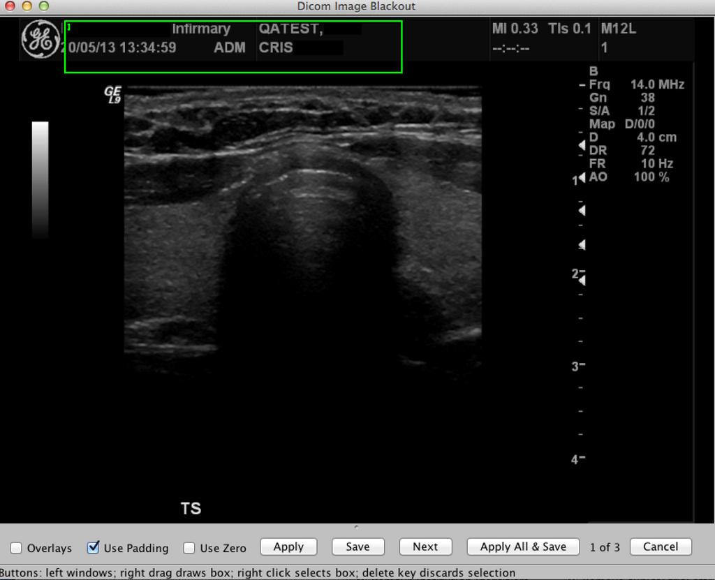 Using DICOM cleaner (3) Using DICOM cleaner BLACKOUT to remove patient details from images If this step is required, highlight your case in right hand pane and click blackout button.