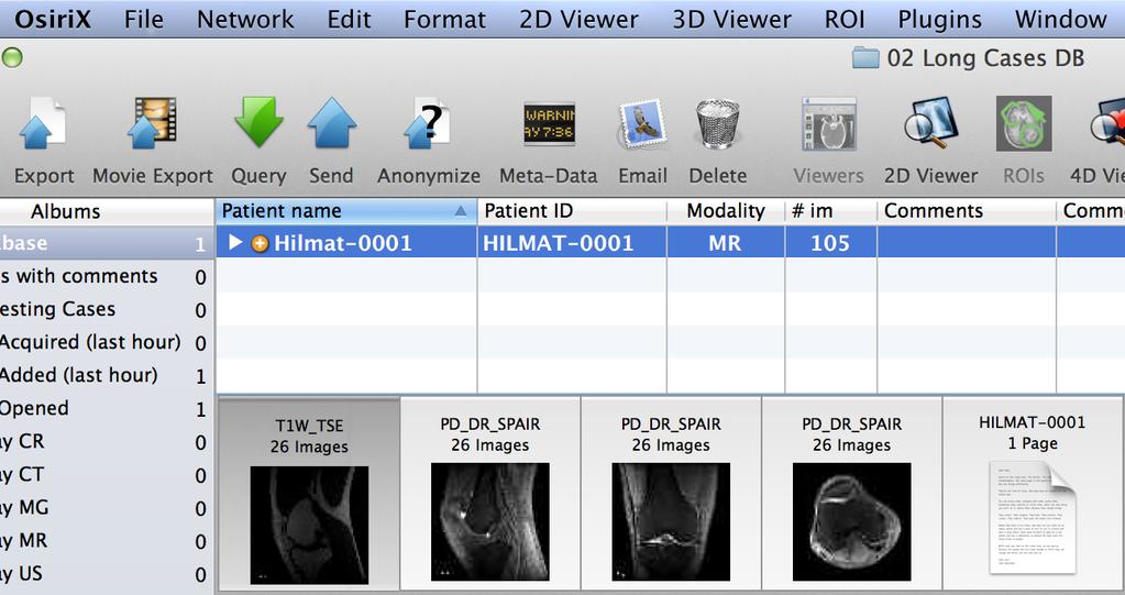 Using DICOM cleaner (5) Finally, import cleaned cases to Osirix; Launch Osirix, then select the appropriate database on your encrypted hard drive in the sources list (red arrow).