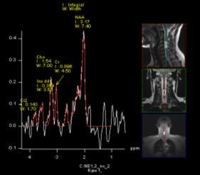 shim fluctuation For spectroscopy in body region.