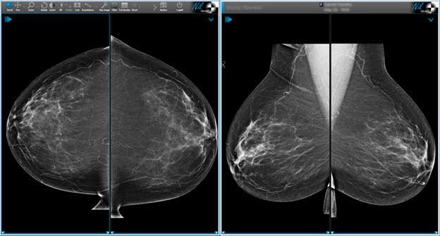 1. Overview Multi-monitor auto-aligned mammography hanging protocol Non-symmetric 2x1-1/3