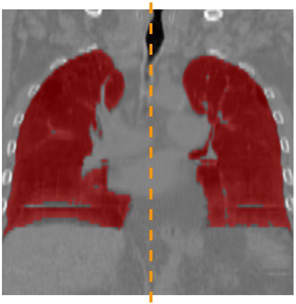 few dense structures in the lungs. It is therefore possible to adjust the detection thresholds based on the number of detected artifacts.
