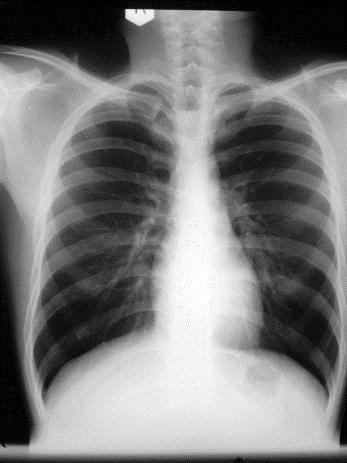 Table 1: X-ray images for lung Cases and its numbers Type of Images Number Of Images Tuberculosis X-ray 172 TB X-ray 163 Normal X-ray 122 3.