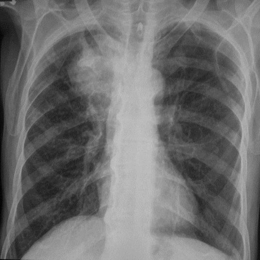 Input Data Generation Algorithm Input: Output: Chest X-Ray Inputs arrays and Outputs Labeling Step 1: Start. Step 2: Request Images from folders for each case of lung (TB, tumors and normal).