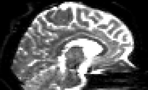 EPI distortion Diffusion MRI uses fast acquisition Echo planar