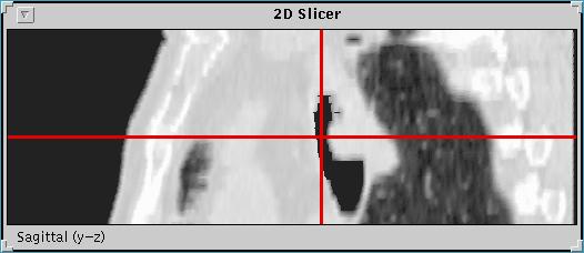 6. See global 2D slices at cancer site. Note severe narrowing due to cancer. The 2D Slicer gives global 2D cuts through a view site.