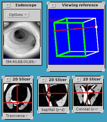 2. See Virtual Endoscopic View and 2D Slices.