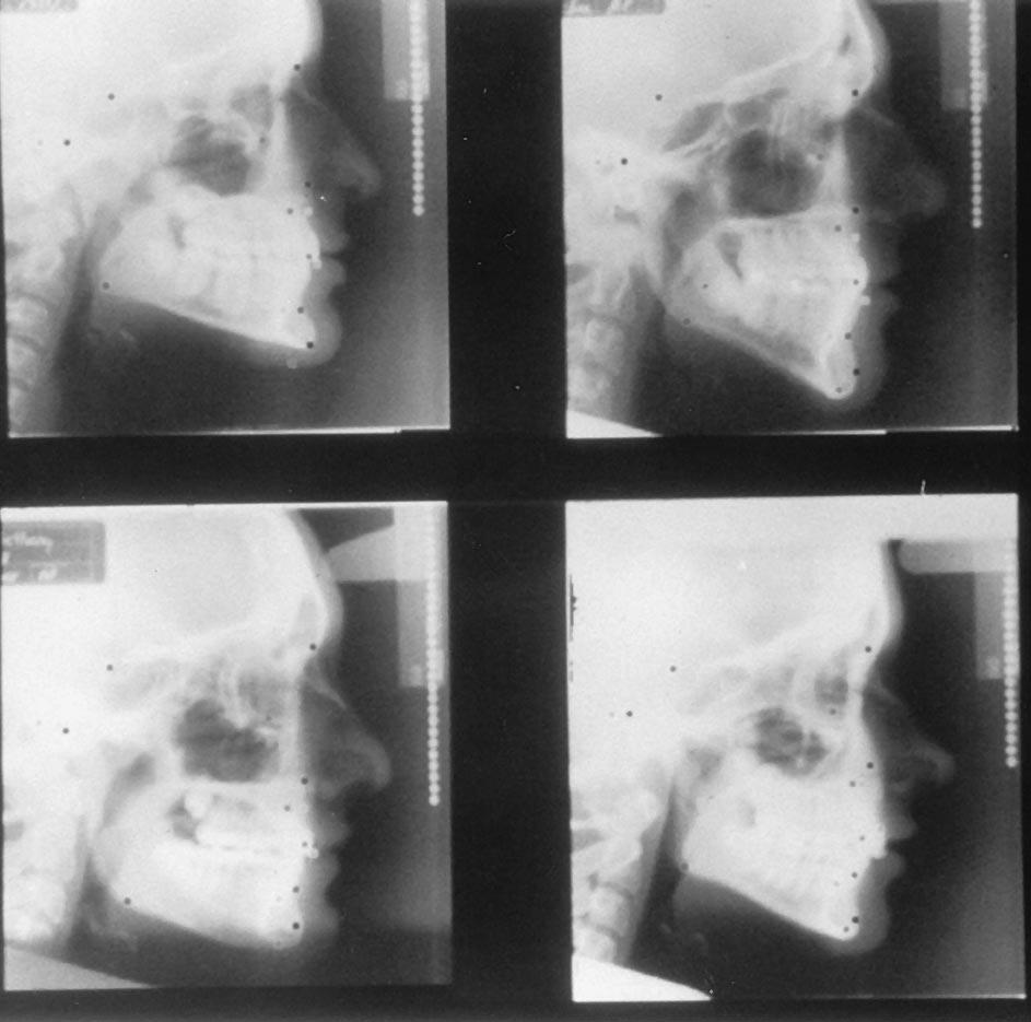 178 Rudolph, Sinclair, and Coggins American Journal of Orthodontics and Dentofacial Orthopedics February 1998 Fig. 3. Four typical examples of automatic landmark identification.