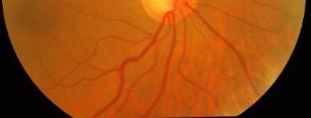 differential window. OD boundary is detected using the following steps. Color fundus image shown in Figure 3.
