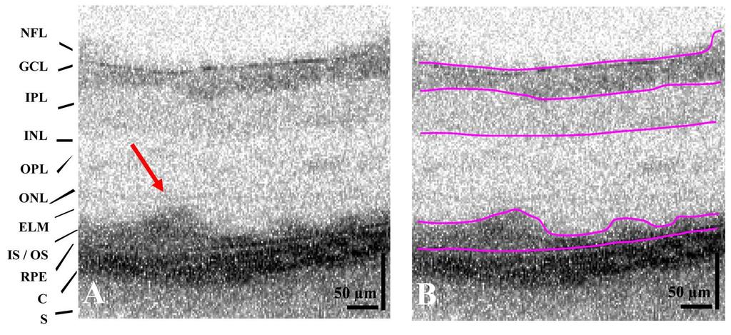 Fig. 4. OCT cross-sectional tomograms (1000 x 250 pixels) of a diseased rat retina acquired in-vivo. Fig. 4(a) shows the original, unprocessed image, while the segmented image is shown in Fig. 4(b).