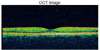 The Heidelberg Retinal Tomography is possibly the most common example of this technology. 3. SCANNING LASER POLARIMETRY (SLP) This [8] method uses a 780-nm diode to illuminate optic nerve.