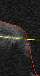 (b) Illustration of search region for testing set which is an ellipse with the same size as the outer ellipse (dark blue) of the donut around the estimated 3D BMO location (yellow cross).