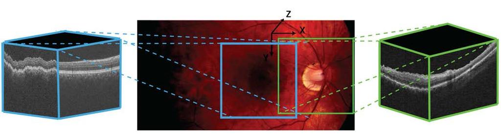 In contrast, optical coherence tomography, which is also a noninvasive modality, is capable of 3D imaging of different retinal structures that contain high-resolution (micrometers) and
