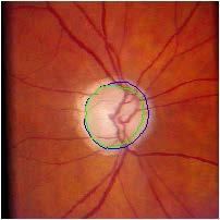 Furthermore, it has been shown that there is a significant correlation between the RNFL thickness (RNFLT) measured along the tracts of fiber bundle and the neuroretinal rim thickness and the
