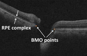 (a) (b) (c) (d) Figure 2.2: Bruch s membrane opening (BMO) within an SD-OCT volume. (a) An SD-OCT B-scan with BMO points marked with two filled circles. RPE = retinal pigment epithelium.