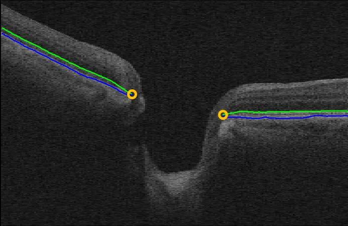 EOBT cases because in presence of EOBT, the closest point to the ILM may fall on the anterior surface of the border tissue rather than on the BMO (Fig. 5.3).