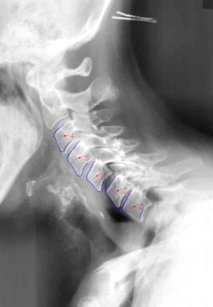Thus, we have proposedd an offline process for vertebrae mean shape modeling and data constrruction.