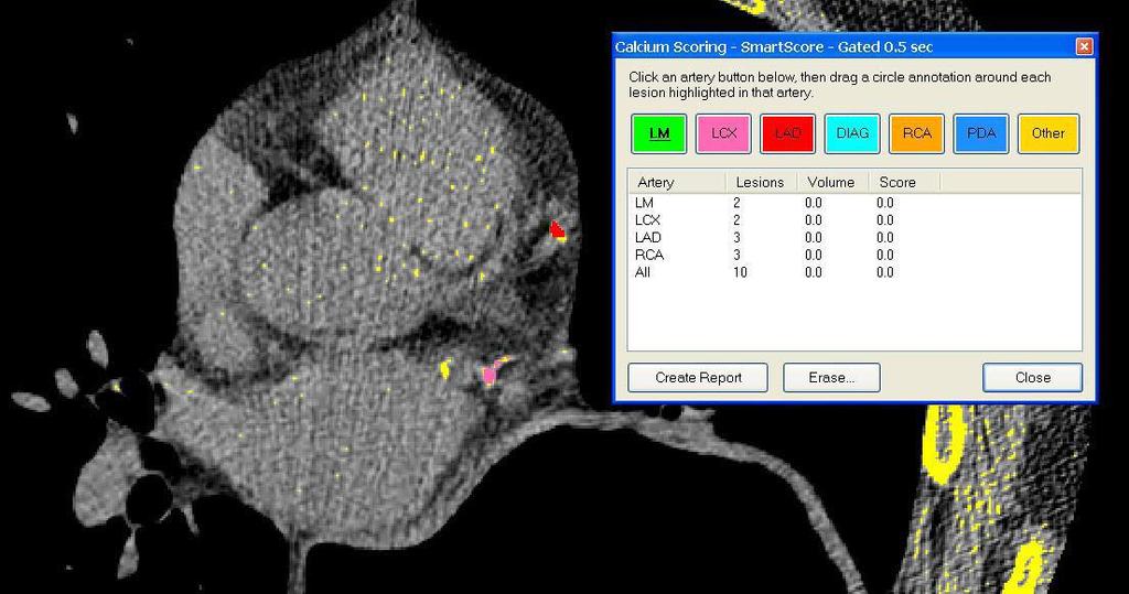 NovaPACS Diagnostic Viewer Chapter 14 Cardiology Features 14-1 Calcium Scoring The Calcium Scoring option allows users to examine CT studies for calcium buildup in the coronary arteries.