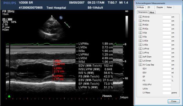 NovaPACS Diagnostic Viewer Chapter 14 Cardiology Features 14-4 Echocardiogram Measurements The Echocardiogram Measurements option allows users to create and analyze measurement annotations for an