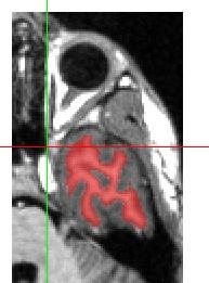 Figure 23 - Segmentation Near Eye Corrected Switch to a coronal view. Check for erroneous segmentation in midbrain structures as in Figure 24. This part of the segmentation will need to be removed.