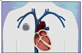 CHAPTER 2 LITERATURE REVIEW This chapter describes what is pacemaker, advantages of pacemaker, pacemaker and surroundings and material characteristics for each