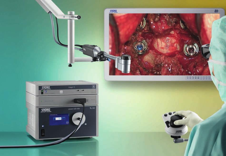 VITOM 3D 3D Visualization for Open Spine Surgery The VITOM 3D system provides many surgical disciplines with a revolutionary solution for the visualization of microsurgical and open surgical