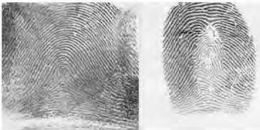 c) Imitation Friction ridge patterns on fingertips can still preserve fingerprint-like pattern after an elaborate procedure of fingerprint alteration: 1) a portion of skin is removed and the