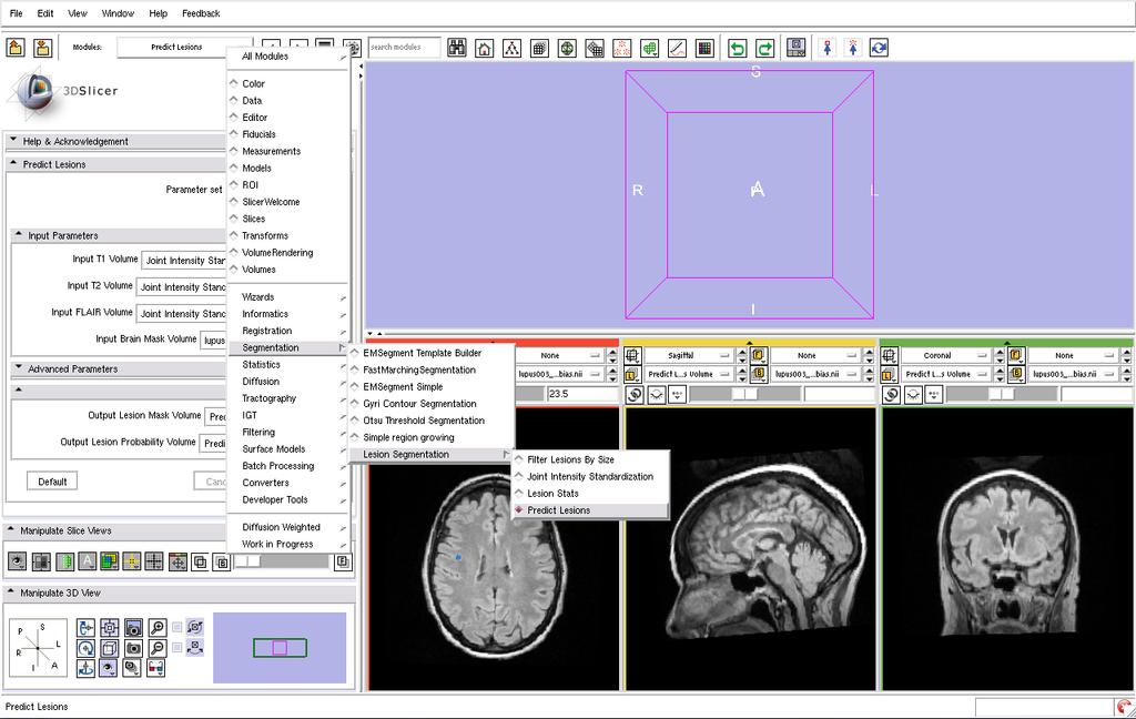 Step 3: Setup The next step is to select the Predict Lesions module: Select and expand the Module