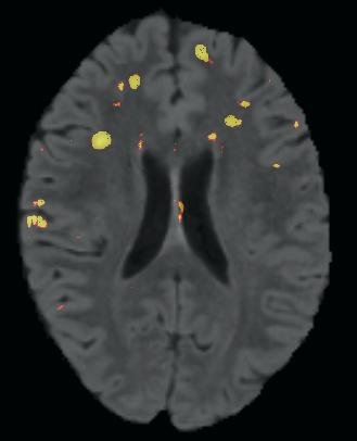 Learning objective This tutorial demonstrates an automated, multi-level method to segment white matter brain lesions in lupus.