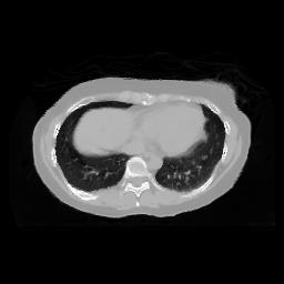 limited-angle CBCT images of liver patient data.