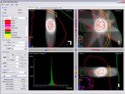 difference, DVH changes, dose analysis per ROI, ROI quick stats and by beam s-eye-view images. All of these analysis tools are included in 3DVH.