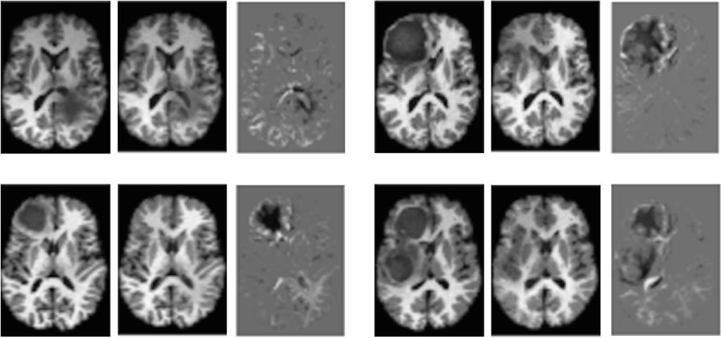 6 Liu et al. Input Low-rank Sparse Input Low-rank Sparse (a) 4/20 simulated T1 brain volumes with the corresponding low-rank and sparse components (during the 1 st iteration).