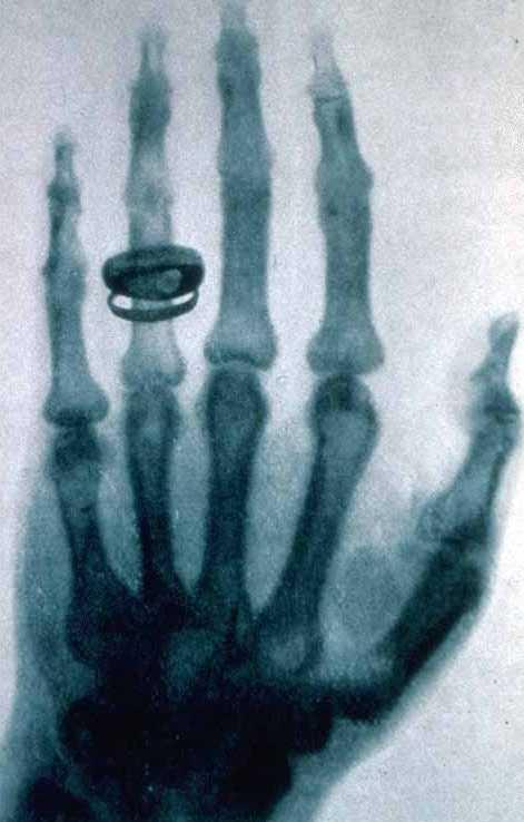 X-Rays X-rays discovered in 1895 by Wilhelm Roentgen (won the first Nobel price in