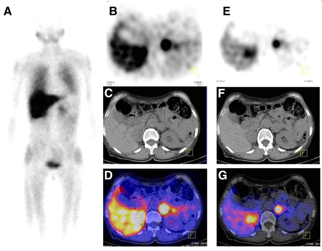 SPECT SPECT / CT Radiation source inside the patient, functional images of metabolic processes.